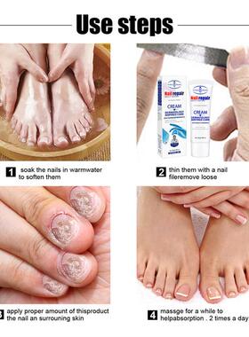 Effective Nail Fungus Treatment Cream Foot Toe Nail Fungus膏