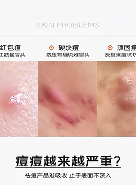 衡美肤祛痘点涂痘精华凝露精华液凝胶大颗青春痘红肿痘去痘
