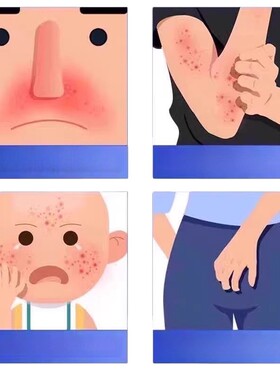 庐永制药乳膏不含激素莫司软膏20g国货