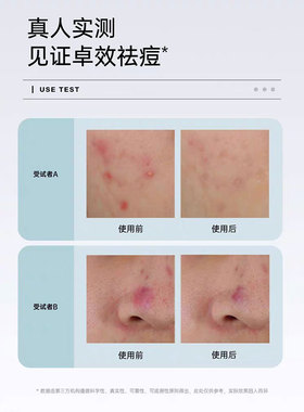 碧绽美壬二酸调理凝胶舒缓祛痘