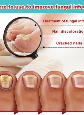 3PCS South Moon FUNGAL NAIL PATCHES