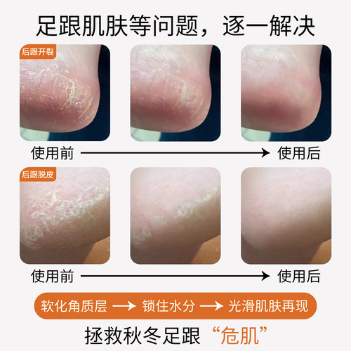 纯棉防裂脚后跟干裂袜子女秋冬100%正品全棉抗菌保湿护足中筒长袜 - 图1