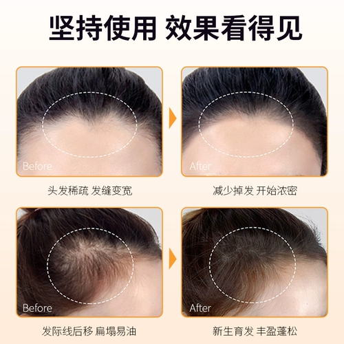 Сыворотка для роста волос, шампунь, кондиционер, контроль жирного блеска, придает объем