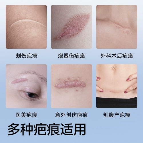 Жендская кесарева сечение