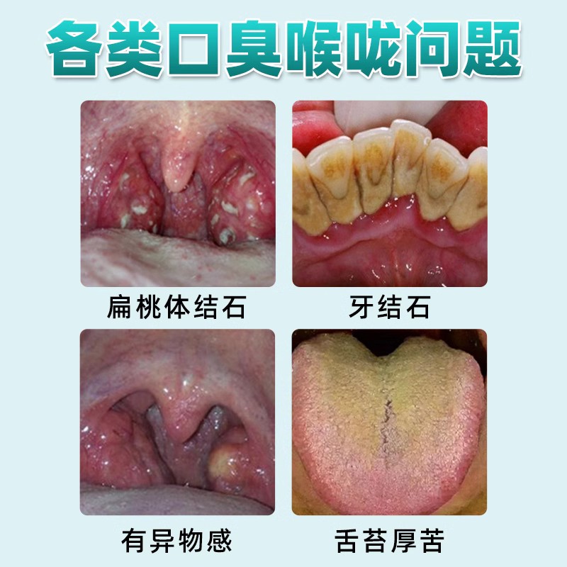 史医生口咽冲洗器去口臭口气牙结石口腔异味护理杀菌专用LT-图1