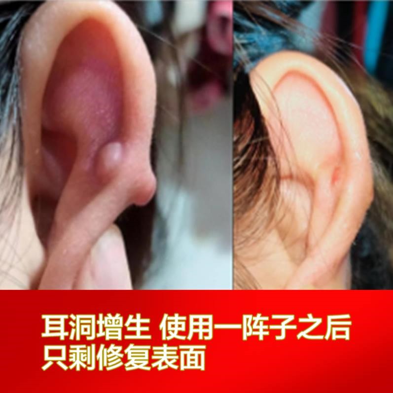 去除耳洞增生疙瘩疤痕增生耳骨凸起胸前瘢痕贴瘢痕疙瘩软化修复膏_虎窝淘
