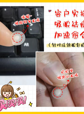 【108贴】护妍天使隐形痘痘贴祛痘净痘遮瑕吸脓救急积雪草传明酸