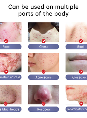Herbal Acne Treatment Cream Pimple Spot Removal for Teens Oi