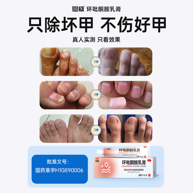 Ciclopirox amine cream 1%*30g*1 tube/box Antifungal special medicine for onychomycosis and athlete's foot