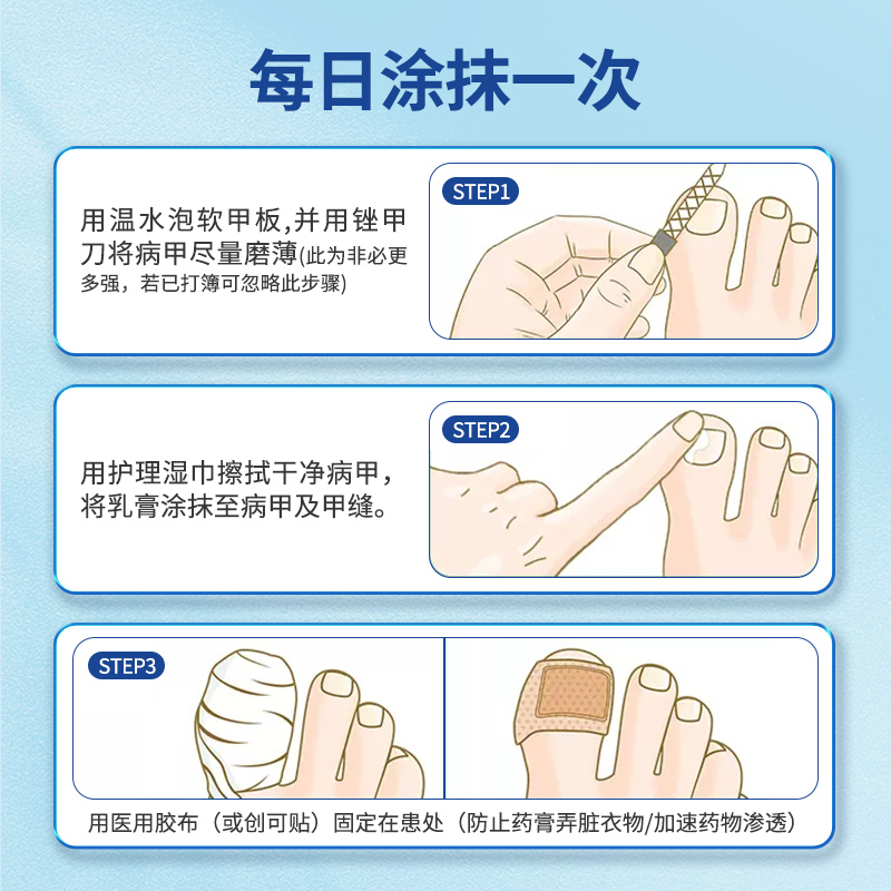  恩威癣症