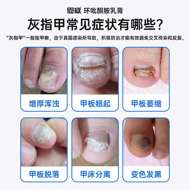 Ciclopirox amine cream 1%*30g*1 tube/box Antifungal special medicine for onychomycosis and athlete's foot