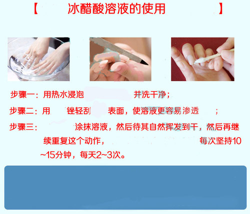 10%冰醋酸溶液涂剂搽剂涂甲泡手脚 2500ML消中和清理角质男女 - 图1