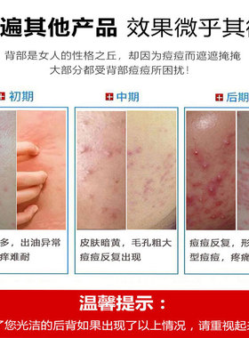 和背部痘痘说拜拜祛消痘爽肤炎水