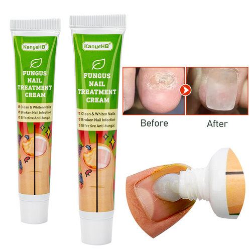 Nail Fungus Cream 20g指甲膏 ebay Lazada Joom跨境热销Shopee - 图0