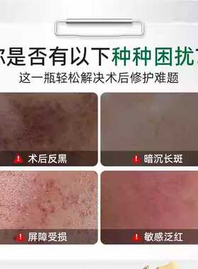 植仆氨甲环酸祛斑霜抑黑焕亮去黄提亮淡斑改善暗沉祛斑霜