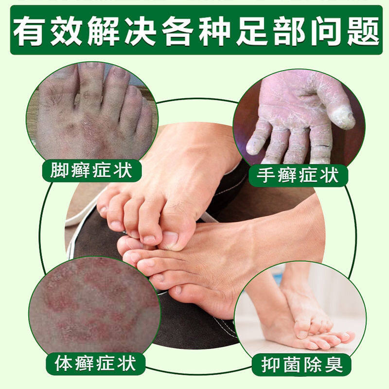 唯达宁脚气药脚痒脚臭脚汗脚气喷剂 世纪本草大药房癣症