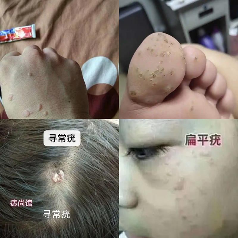 农家无花果原浆纯白浆乳液无花果茎枝汁涂扁平药用现挤外用包邮-图0