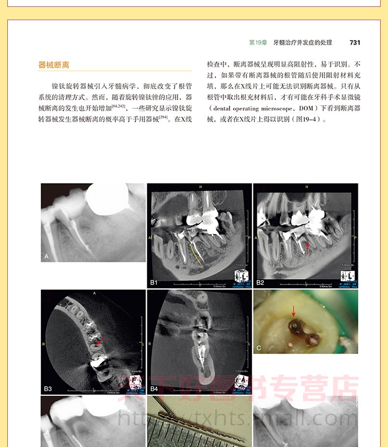 牙髓之路第11版第十一版牙髓治疗并发症的处理口腔科学书籍医学类专业书籍牙科牙髓治疗根管治疗图谱牙体牙髓病学临床牙髓再生技 - 图2
