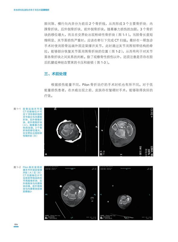 正版包邮 积水潭医院创伤骨科手术技术 足踝骨折 北京积水潭医院手术经验全景展示 北京科学技术出版社9787571412326