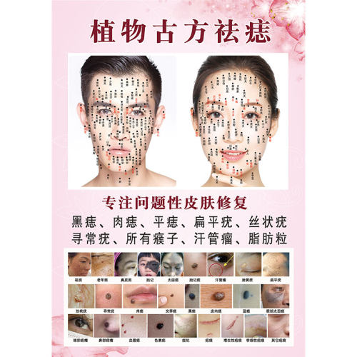 男女面痣图点痣海报脸部取痣宣传画植物古方祛痣图祛斑祛疣广告图 - 图3