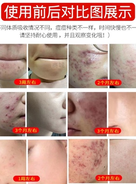草本高效净豆消印亮肤控油收缩毛