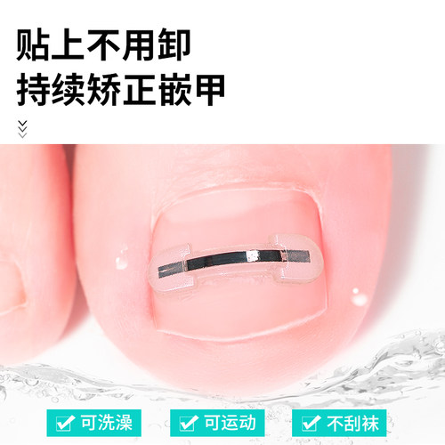 脚医生甲沟嵌甲矫正器炎正甲贴贴片脚趾指甲往肉里长专用指甲刀剪 - 图2