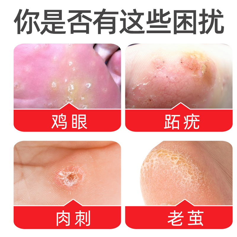⭐脚医生⭐旗舰店鸡眼膏鸡眼贴刺猴脚肉刺疣膏趾疣净手部足部瘊子
