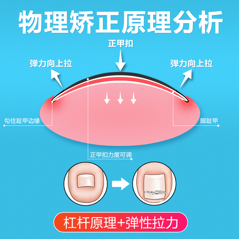 甲沟矫正器嵌甲矫正器正甲扣脚趾甲卷甲正甲贴片指甲长肉里神器炎 - 图1