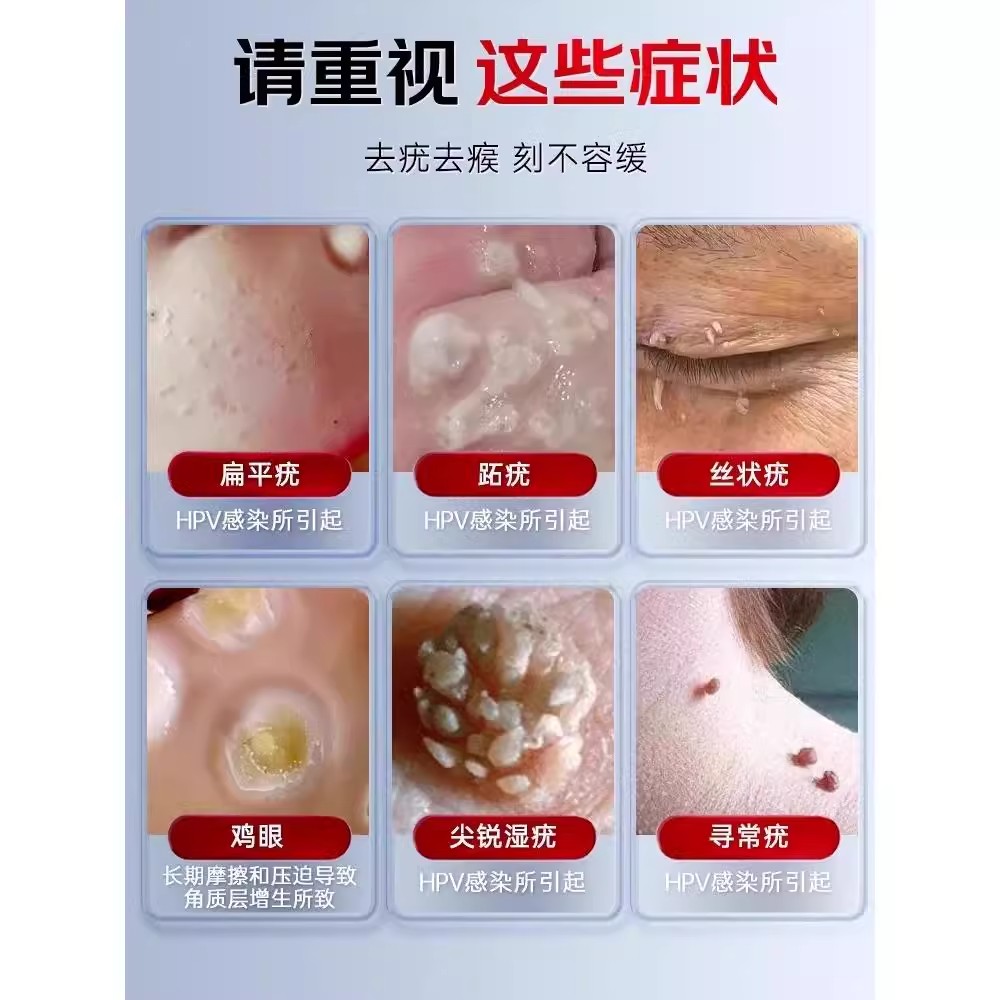 哲也医生祛疣型医用退热凝胶去尤膏医疣瘊用扁平疣官方旗舰店正品