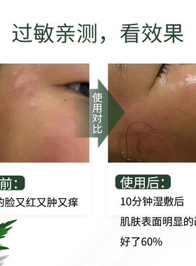 油皮亲妈去闭口粉刺黑头艾草纯露