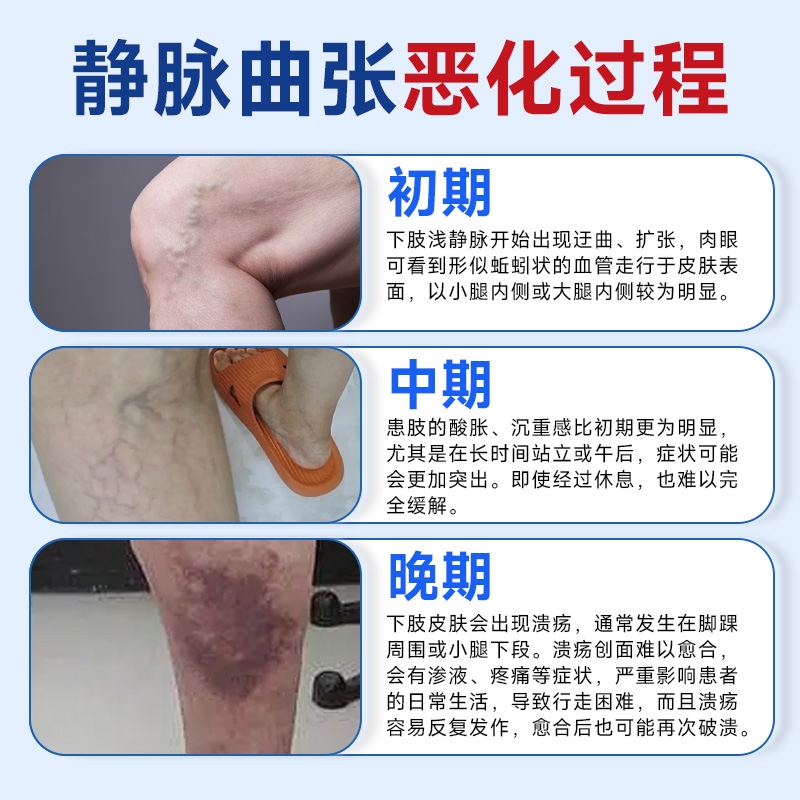 苑医生医用远红外静脉曲张治疗凝胶促进局部血液循环辅助消肿B - 图2