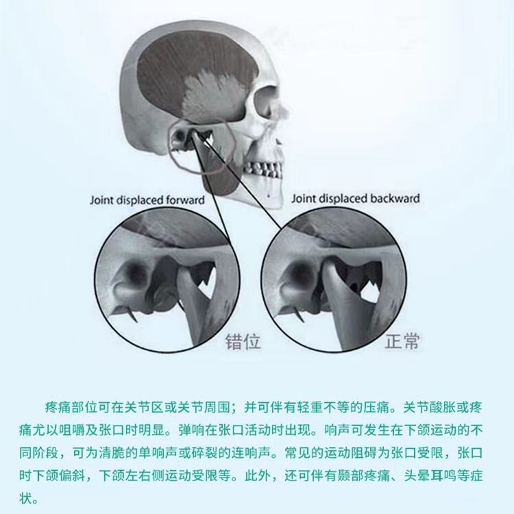 张口训练器扩嘴器口腔张嘴下颌康复锻炼扩张唇肌扩张器嘴巴家用 - 图0