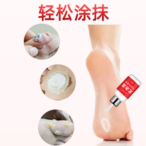 脚医生鸡尤净跖疣鸡眼膏贴寻常跖疣膏瘊子尤小肉粒去除一抹灵软膏 - 图3