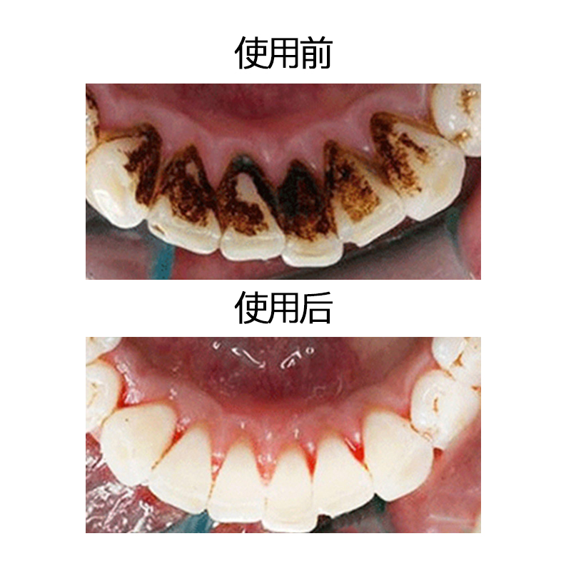 洗牙粉去黄洗白去黄牙美白速效黄牙洗牙齿污垢除牙石烟渍牙垢神器-图1