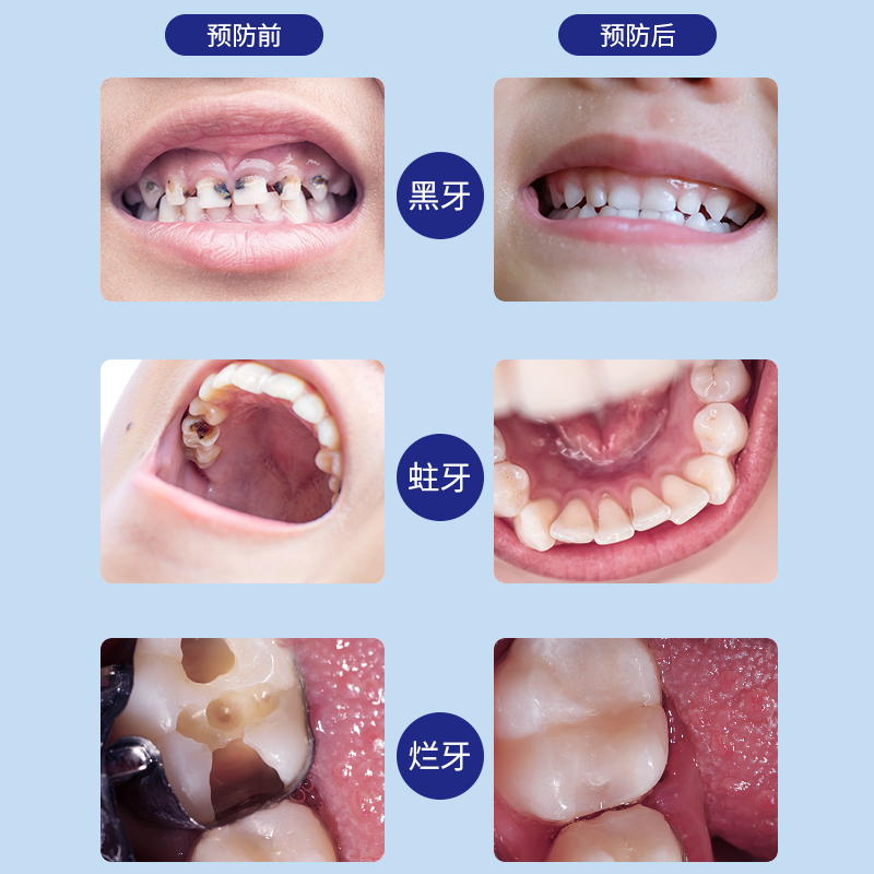奥拉氟儿童牙膏1一3一6-一12岁含氟益生菌换牙期防蛀龋齿蛀牙中华 - 图0