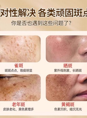 点斑水无痕脸部去黑美容金水志水美容院专用点班痣神器旗舰店