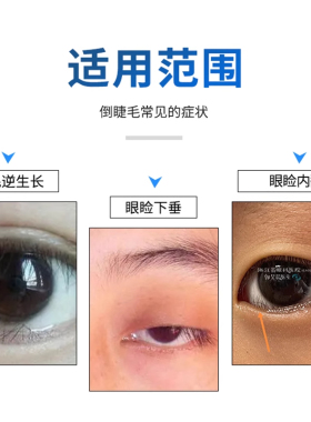 倒睫毛矫正专用神器成人儿童