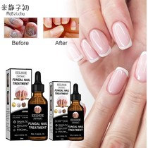 Nail repair lotion thickened light A to grey nail dead leather repair and nourishing mealid Care fluid Fashion Beauty