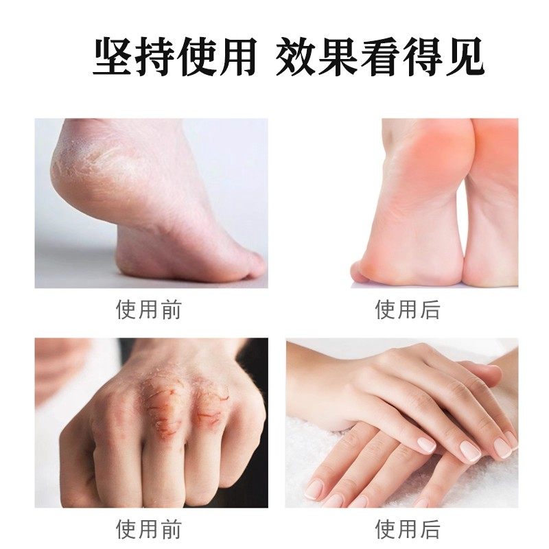 马油干裂贴凡士林手足手指脚后跟皲裂防冻干裂专用秋冬裂口贴4tm - 图2