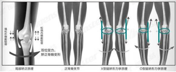 带腿矫正儿童O型腿矫型器 仙享科技 淘宝特价大促销打折疯抢! - 图2