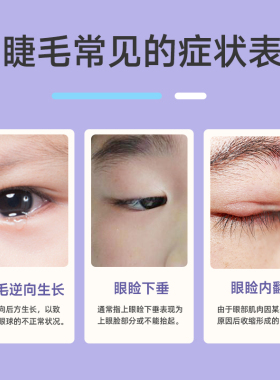 【眼科推荐款】倒睫毛矫正贴