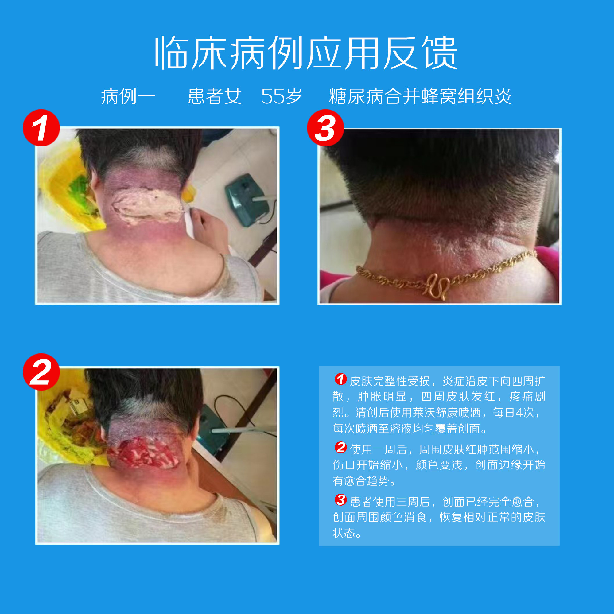 莱沃舒康30ml50术后生物胶体分散剂 沃派尔医疗器械6864卫生材料及敷料