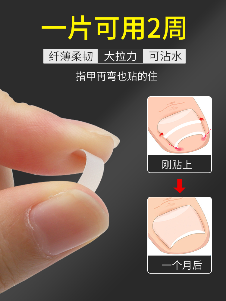 正甲贴甲沟矫正器嵌甲贴片脚趾甲炎拉拉贴矫正神器修脚刀工具套装 - 图0