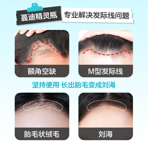 发际线专属蔓迪生发精灵瓶米诺地尔酊上药器男女防脱发增长液精华 - 图1