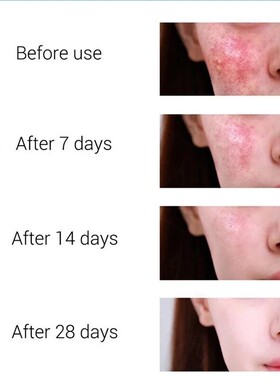 Effective Acne Removal Cream Treatment Acne Scar Spots Cream