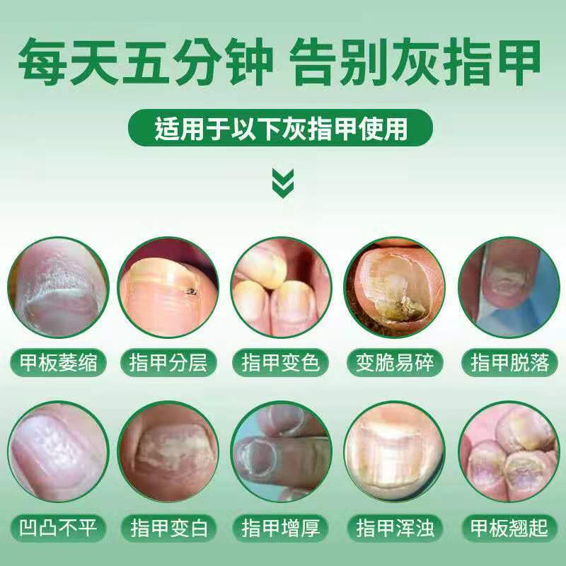 去灰指甲特效液发黑分离去除增厚灰甲亮甲脱甲膏喷剂专用抑菌液 - 图2