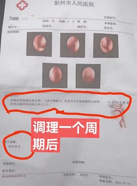 鼻炎腺样体肥大鼻窦炎鼻甲肥大熏蒸一个疗程见效综合调理