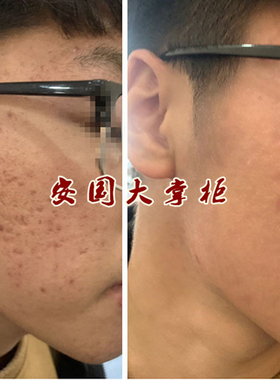安国面霜纯中手工药焕颜天然去豆膏去豆印清爽草本修护霜敏感肤质