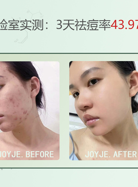 祛痘精华液淡痘印闭口粉刺青春痘