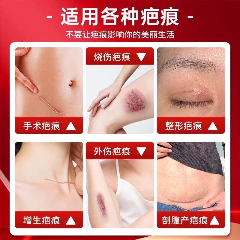 修正医用疤痕贴剖腹产手术增生痘印烧烫伤祛疤痕修复除疤硅酮凝胶